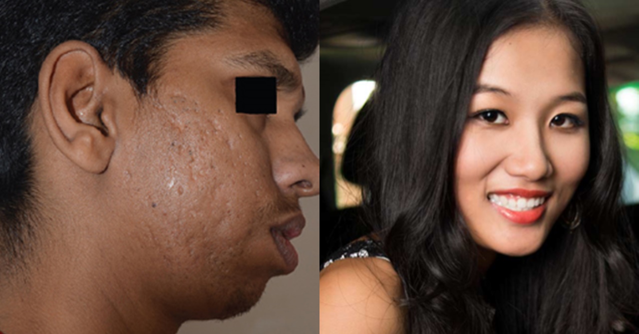 Tinanggap ng Dalaga ang Ka-Date Kahit Maiksi ang Isang Paa Nito at Tigyawatin, Ikinagulat Niya nang Malaman ang Totoong Pagkatao ng Binata - Inday Trending