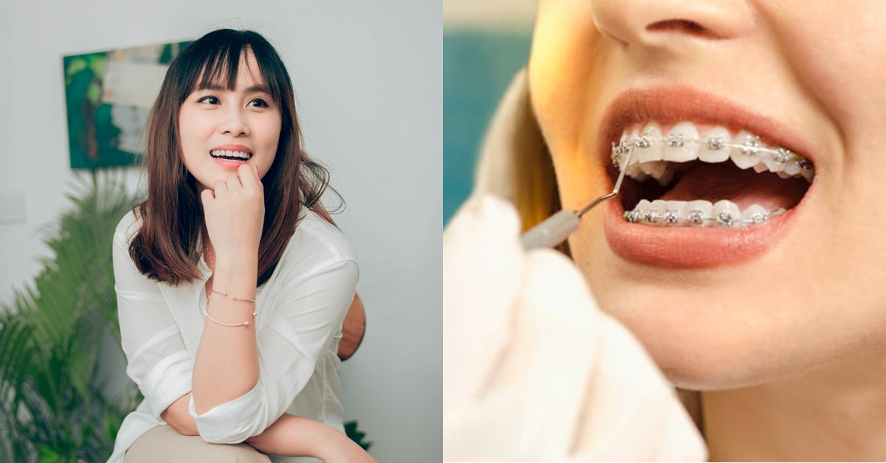 Panay ang Pagpapaayos ng Parte ng Katawan ng Dalaga, Kumagat pa Siya sa Murang Dentista para Magpa-brace ng Ngipin